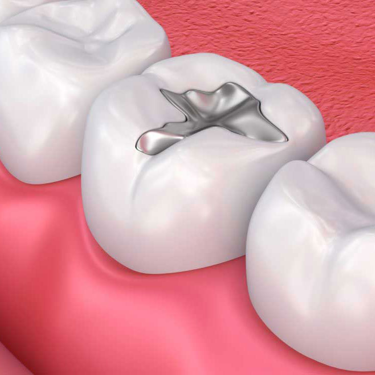 Tooth Colored Fillings